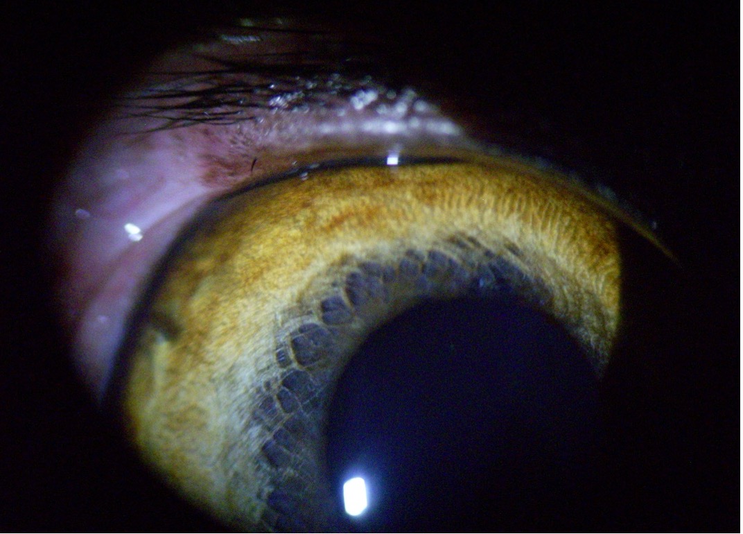 rendellenes szempillák