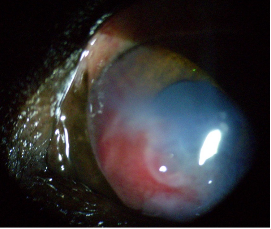 rendellenes szempillák